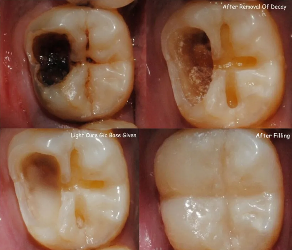 Tooth Cavity